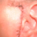 Ear was shortened, stitched to face, scarred and draped 