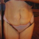 surgery scars and pouchy overhang belly - hideous !