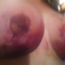 Right booobie 600cc2 days post