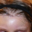 Brow lift