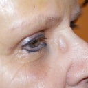 eyelid lift