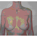 Uneven nipples that were even before Dr. Rand's surgery nine years ago.
