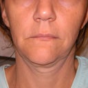 Facelift did not hold, doc did more lipo on my neck which he should of left the fat to fill in the loose skin.  This proceed was done with out my approval.