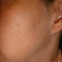 other ear is pixie,  hope to have this fixed sometime not willing to be put back under and loose more hair.