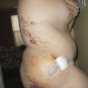 one week post op side view Bruising from Lipo
