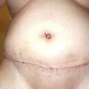 two week post op after tape removal CLOSEUP