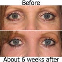 These photos are WITH makeup. The skin under my eyes are still BRIGHT pink, but the results so far are remarkable! The skin under my eyes were not this smooth in my early 30's. I'll update more as the healing continues.