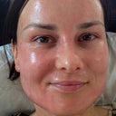 Exactly three days after the procedure. I am now peeling and the skin beneath looks pure. I've already gone out in a big wide-brimmed hat. I've told people I'm being treated for a skin condition. :-) (ie. sun damage)