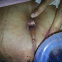 Navel hole big still have drain
