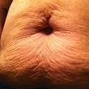 YUCKY!! Can't believe I'm uploading this :-)...At 120, this becomes worse (from my weightloss experience after my son). But nevertheless I need to get down to 120 before my consult in May. Despite how ugly this looks, I still would go through my pregnancies and have my wonderful kids if I had to do this all over again in another life :-)!!