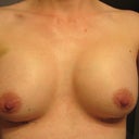 Day 6.  Left one (right in the pic) seems larger and a little higher.  Maybe because I'm right handed?  I've heard the side you use most will drop quicker.  True or not?