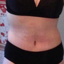 7.5 weeks post TT and BL
