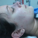 After surgery, right side (profile)