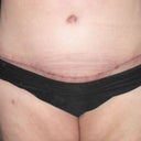 After - 4 weeks post-op tummy tuck and lipo