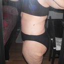 After - 4 weeks post-op tummy tuck and lipo