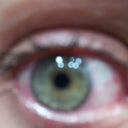 this is after visine