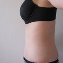 2 weeks post-op side view close-up