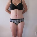 2 weeks post-op front view