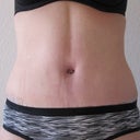 2 weeks post-op front view close-up