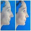 This was the computer image from my surgeon. I was sold!