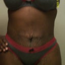 Front view 5 weeks post op