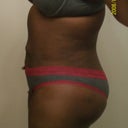Side view 5 weeks post op