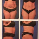 Before and after pics from my surgeon's office.  Really amazed at the difference before and 5 months post op.