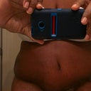 Front at 5 weeks after 2 weeks with compression garment