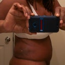 Side five weeks after 2 weeks in compression garment