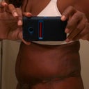 Side at 5 weeks after 2 weeks in compression garment