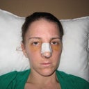 3 days post-op front (not at my best!)
