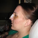 face, cheeks & bridge very swollen!