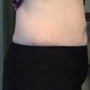 Bathing Suit After, Left (2 Weeks)