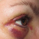 5 days after right eye - bruising is from fat removal
