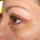 5 days after left eye