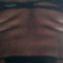 JANUARY 2011 3 months BEFORE surgery