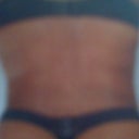 JULY 2011 3 months AFTER surgery