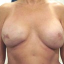 Front view after 475cc implants in April 2011. Notice the scar that has not rounded with the breast?