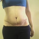 5 wks post op