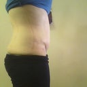 5wks post op side view