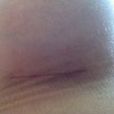 Scar @ 6 weeks. Still red, but totally smooth and no longer puckered. Shrinking considerably!
