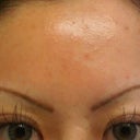 Forehead pink and tender from peeling