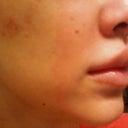 Pink patches are where I coaxed off the skin that was peeling(shouldn't pick though!)
