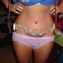 5 days you can see swelling in lower abdominal and around incision