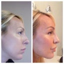this is a pretty rough "before" pic of me but really shows what a difference with the profile and jawline! Should have done it a long time ago..