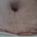 for you SunnySmile : )  These are the stretch marks that I am left with.  The extended about 3 inches above my belly button.  I wish I could be stretch mark free, but unfortunately my dr. is not a magician.  I am hoping they look better when I am done healing.  I still have stretch marks on my hips and thighs, so no matter what I wasn't going to be stretch mark free.  Also, my scar looks scary this close up!
