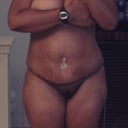 day 3 post op, very swollen but still amazed at how flat I am.