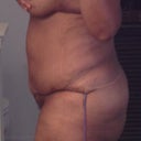 day 3 post op, right side, lots of bruising and swelling
