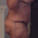 day 3 post op, left side, even more swollen than the right side.