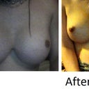 my before and after 2 months =).... My before was done by DR Yarish... not Moliver.